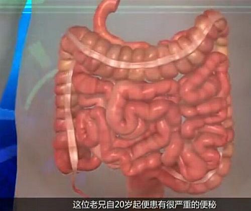 真是没谁了,男子3年没大便被屎憋死,留下的一根大肠重达45斤