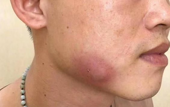 男子脸上长出一个包去医院检查后结果让人意外因为人人都有
