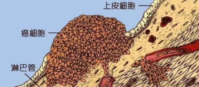 癌细胞与正常细胞的区别在哪里,是什么导致了这种区别