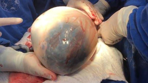 巴西医生接生完整羊膜囊胎儿 概率为1比8万