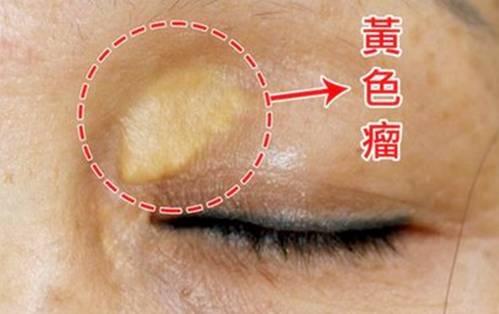 黄色瘤的出现,和胆固醇过高,脂肪堆积有关,是人体内脂质代谢存在障碍