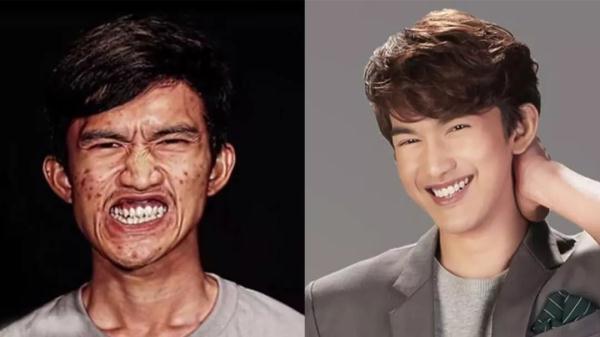 泰国男子因长得太丑,整天躲在家里哭,整容后变成花美男!