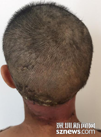 打工阿姨被机器扯掉头皮 医生救命植发成功