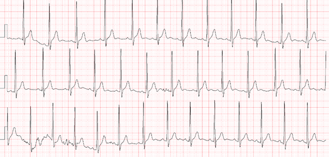 窦性心律不齐,偶尔呼吸困难,会遗传给孩子吗?
