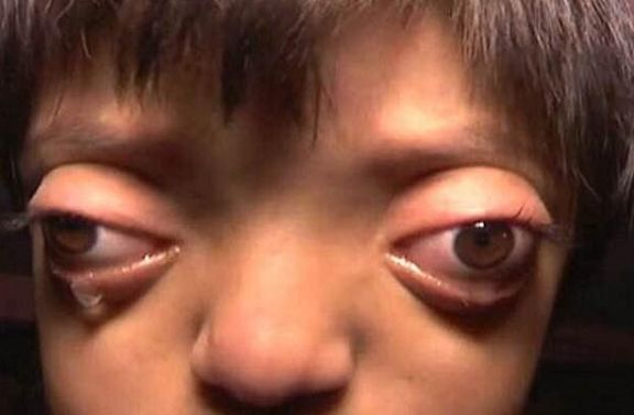 女孩出生眼睛就比较大,父母认为很好看,结果女孩长大后却愁坏了