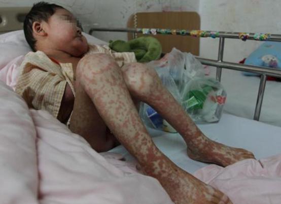 川崎病|东东|高烧_新浪新闻