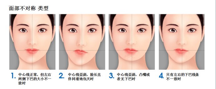 另一种是皮下软组织发育不对称,通常骨骼又分为颧骨和下颌角的不对称