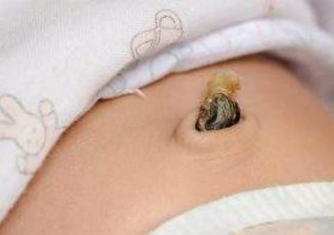 新生宝宝脐带脱落之前, 在护理方面应注意什么? 很多宝妈不清楚