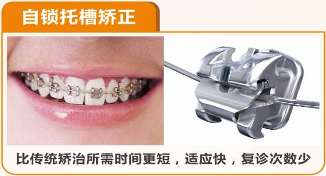 各种牙齿矫正器的种类以及优缺点科普看你适不适合