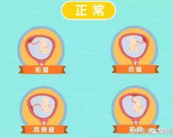 (3)胎盘臀位分为以下四种情况:左骶前(lsa),左骶后(lsp),右骶前(rsa)