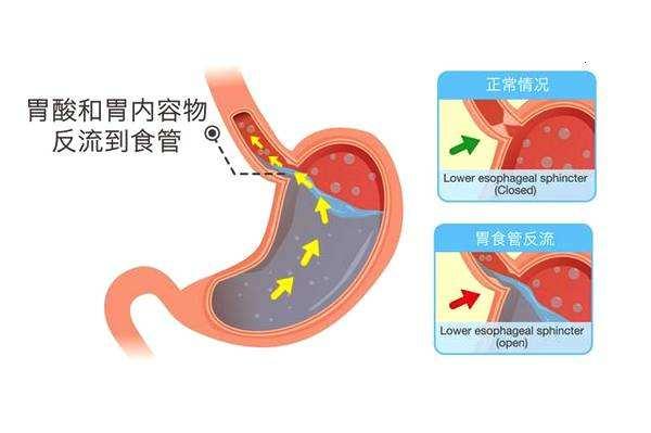 胃燒心,反流,飲食如何調理?做到這4點,身體慢慢恢復