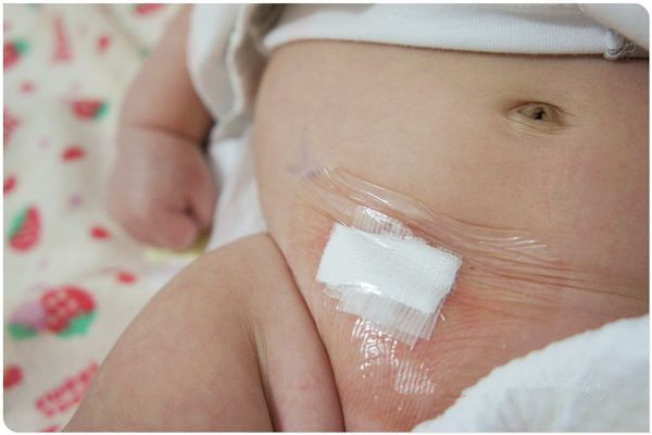 小女孩也可能发生疝气,有99%为间接型,主要与子宫圆韧带的发展有关