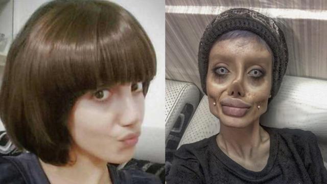 【19岁少女整容50次】伊朗女孩按照安吉丽娜朱莉的样子整容,失败以后