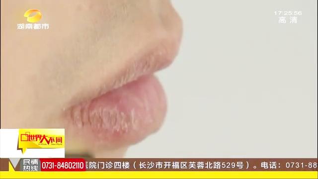 嘴唇脱皮 还在撕死皮 撕皮一时爽 小心撕出唇炎 唇炎 新浪科技 新浪网