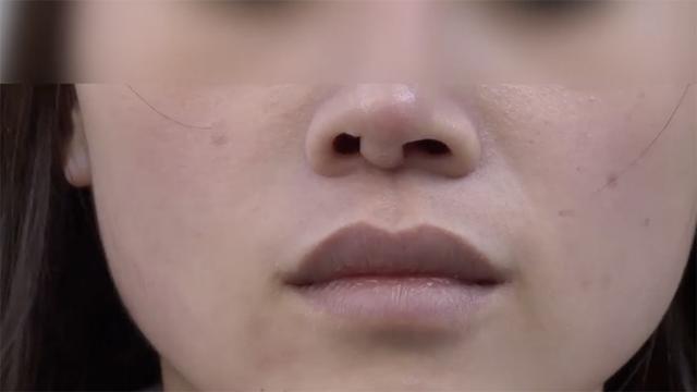 女子生日当天网络贷款3万隆鼻 一个月后鼻小柱凸出鼻孔也歪了