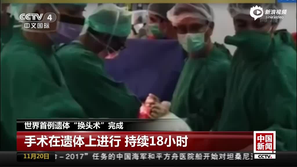 中国教授完成全球首例人类“换头术”耗时18小时