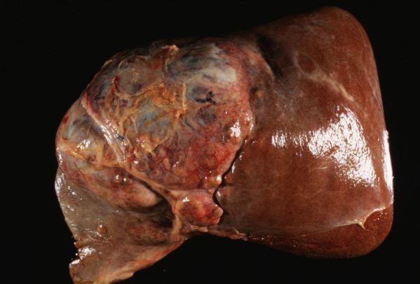 肝脏"硬不硬",看这3个信号,常吃2植物,养好肝防硬化|肝脏|肝硬化|碱性