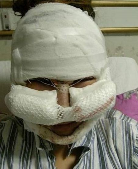 自体脂肪丰脑门,磨颧骨和隆鼻头上缠有纱布,这把全脸都整了啊.