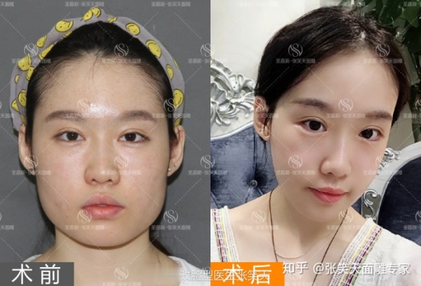 颧骨宽做磨骨手术风险大吗?