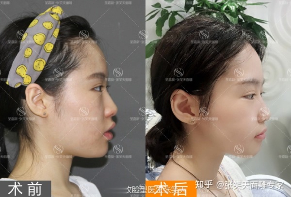 颧骨宽做磨骨手术风险大吗？