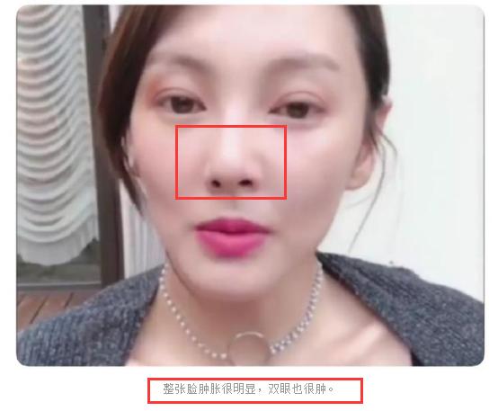 张雨绮疑似整容失败,直播鼻子不对称被吐槽,网友:颜值直线下跌