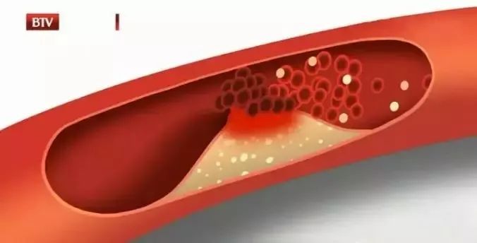 它是心梗,血管堵塞的根源!三个法宝,轻松战胜它!