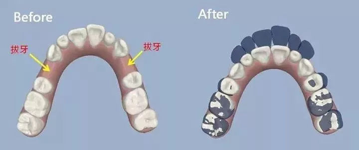 臼齿例如这个案例空出调整的位置拔掉坏掉或不影响生活的牙齿这时候