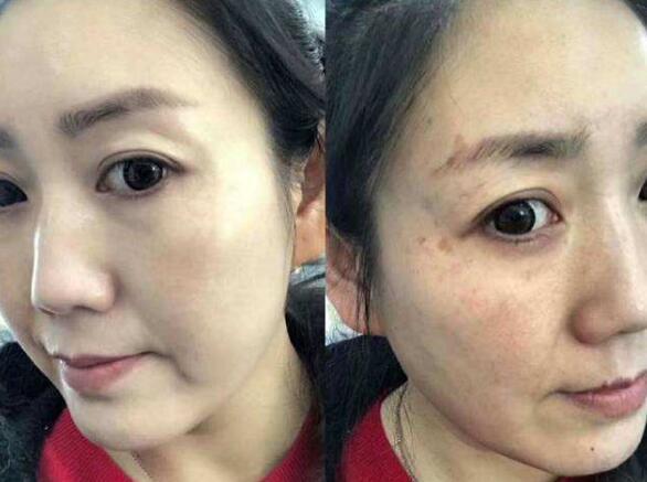 美容专家:黄褐斑反复不要慌!每天坚持这2点,超过10片氨甲环酸
