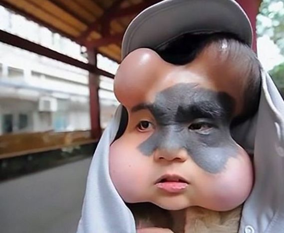 来自贵州的23岁少女脸上植入了四个「气球」状物体,脸型非常奇特,很像