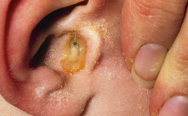 儿童中耳炎的常见症状和正确处理方法建议父母收藏