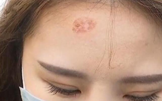 年轻女孩花40元卷发被发型师烫伤额头怒索赔2万还没结婚呢