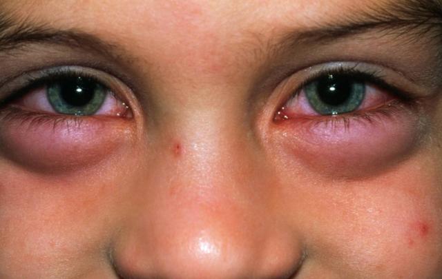 肺癌|消炎|病变_新浪新闻