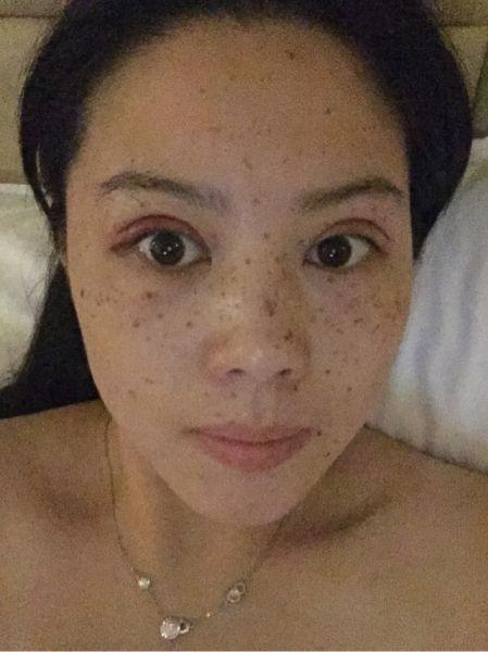 激光祛斑身上,才会呈现确真实短时间内能够看见很好的作用,可