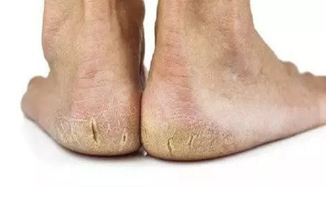 为什么很多人的脚后跟会"皲裂"?这些情况你要了解