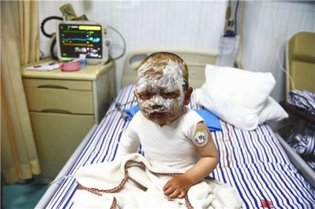 男孩被热水烫伤后宝妈当场这样做,大夫都称赞做得好,家长要看看