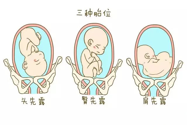怀孕28周,胎儿臀位,胎位是不是固定了?还能转过来吗?|胎位|胎儿|怀孕_新浪新闻