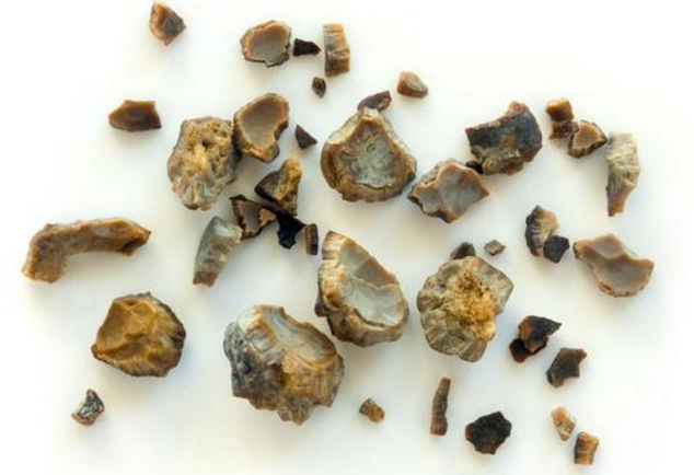 身体有4个"警示",2个方法,溶石降酸保肾|尿酸|肾结石|痛风_新浪新闻