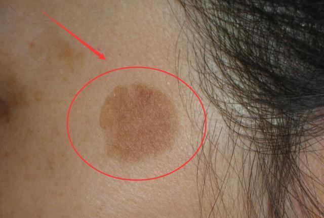 消灭老年斑的"黑科技",5次让斑点消失,周围人全说我变漂亮了