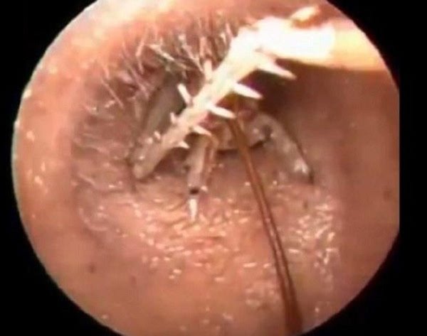 儿子耳朵疼得直哭,爸爸发现耳朵里有东西蠕动,医生:多亏来得快