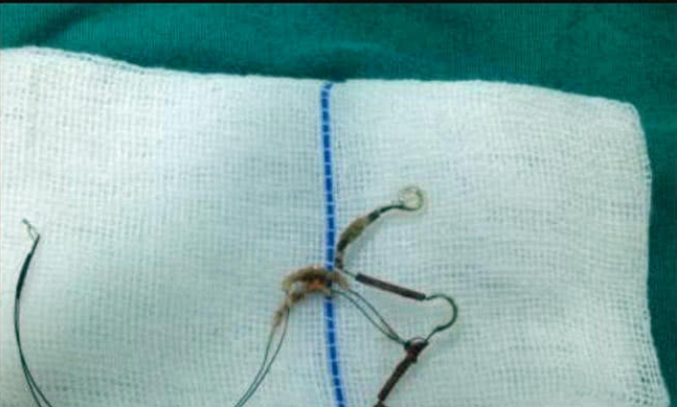 孕妇生完孩子上避孕环10年经常腹痛医生取出避孕环已生锈