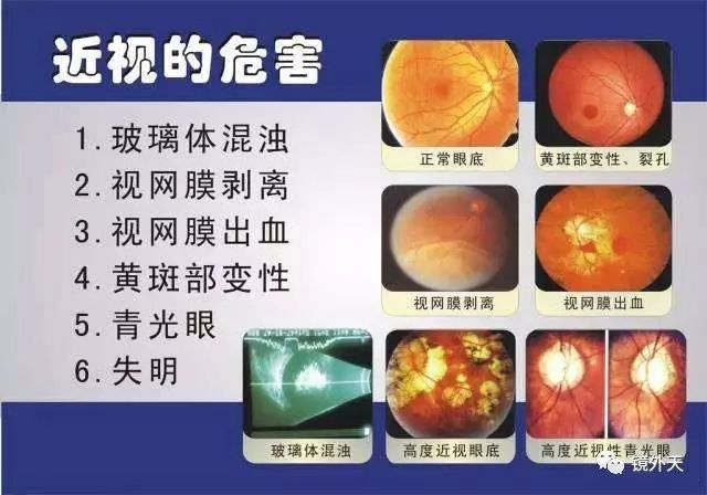近视眼眼部血液供应差,视网膜缺血,视网膜产生一种新生血管生长因子