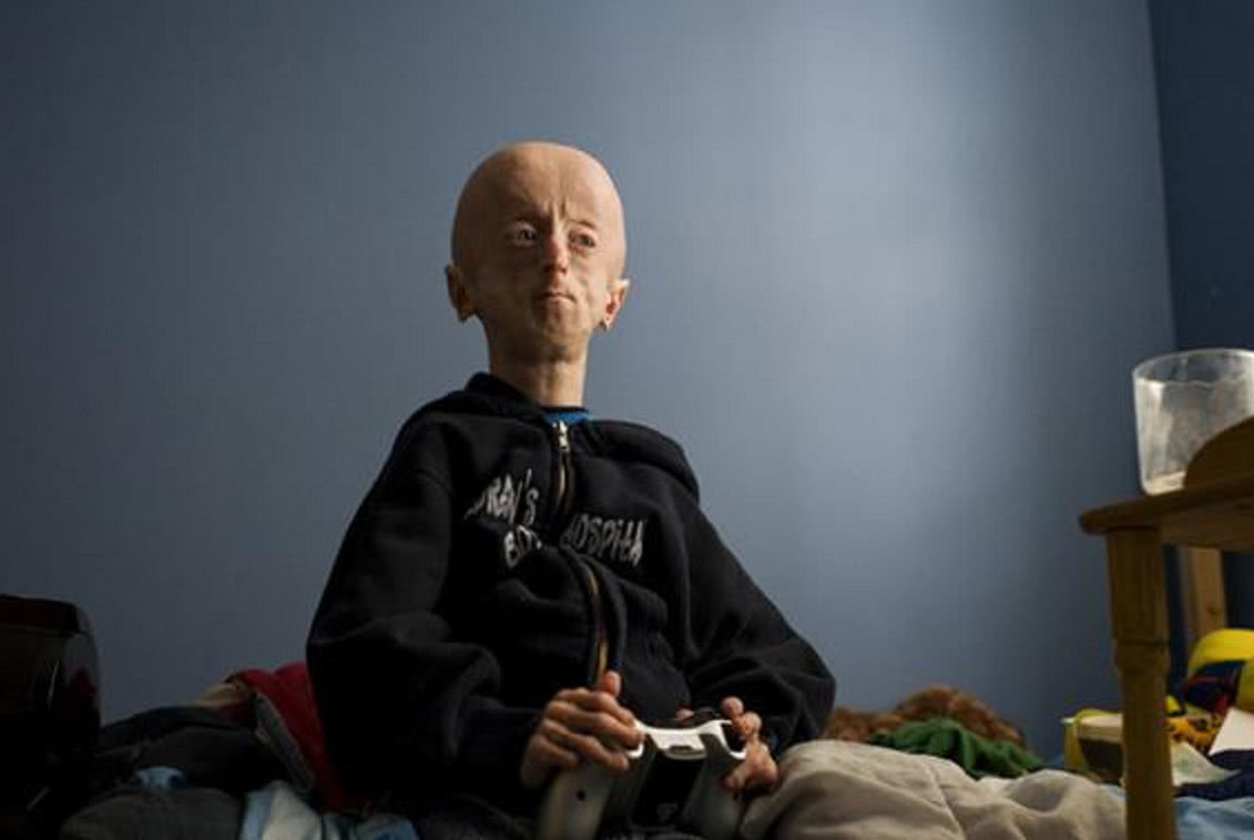 男子患有早衰症,16岁的年龄看着像60岁,邻居都以为是外星人