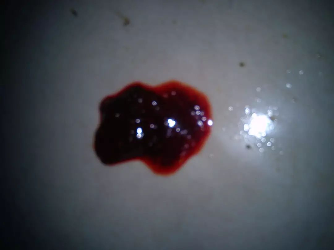 和痔疮的便血不同,痔疮的便血大多是鲜血,而患有肠癌排便时有明显出血