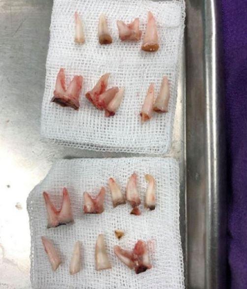 爸妈为方便"喂完奶直接抱去睡",4岁男童整嘴18颗牙齿得全拔光