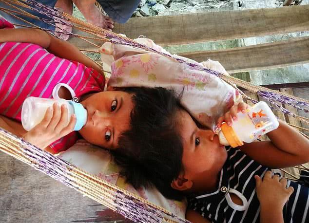 国外连体双胞胎姐妹头部相连,分离手术需75万,而且只能活一个