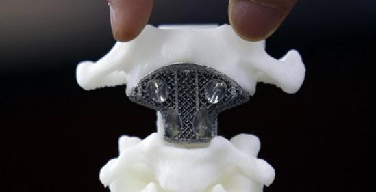 澳医生用3d打印脊椎 成功帮一名患病儿童找回自己