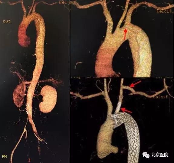 北京医院血管外科主动脉弓上分支重建技术达到国内领先水平