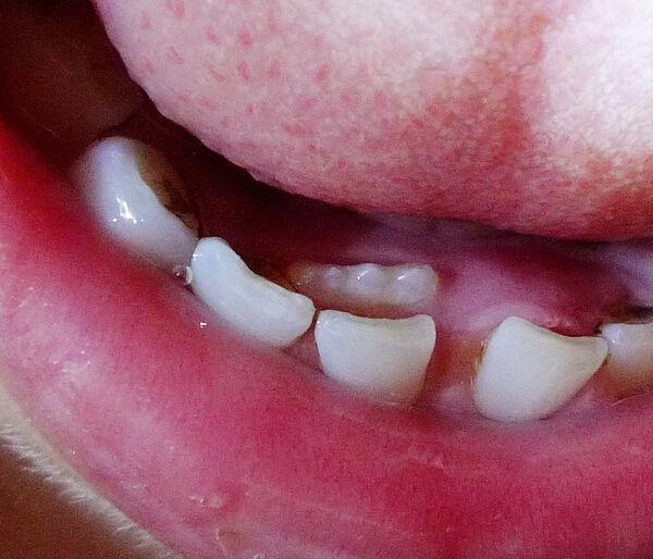 宝宝的"双层牙"是这样被"喂"出来的, 很多妈妈都还在犯