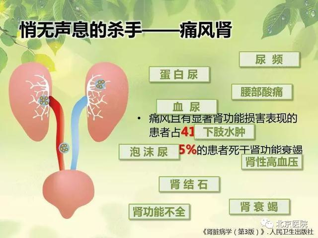 肾结石反复发作,您能想到是痛风在作怪吗?