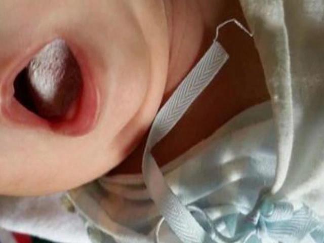 奶奶用毛巾擦了孩子此部位,导致孩子患上败血症,家长值得重视